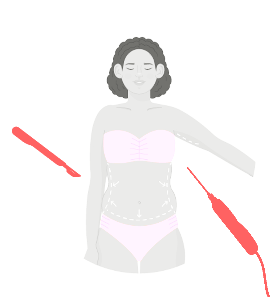 Laser Lipolysis