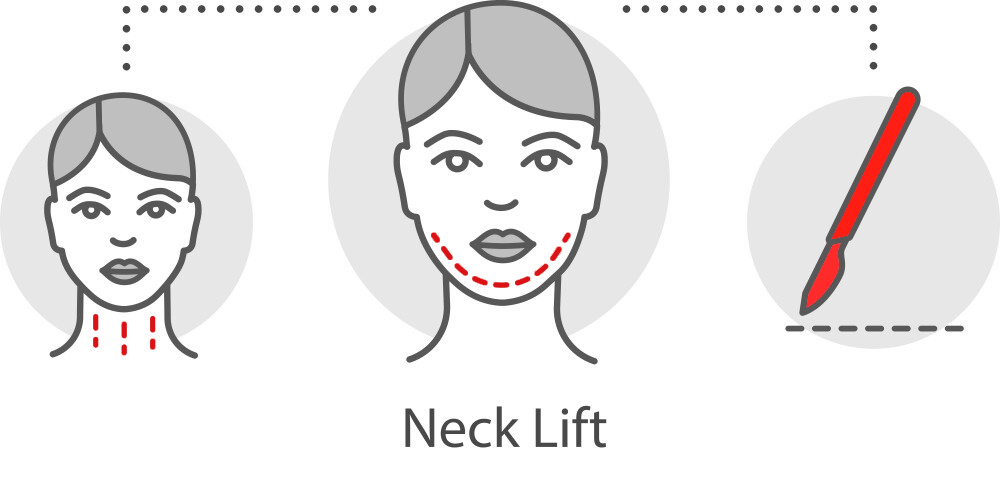 Neck Lift