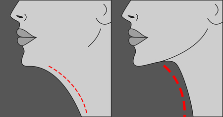 Facial Feminization Surgery