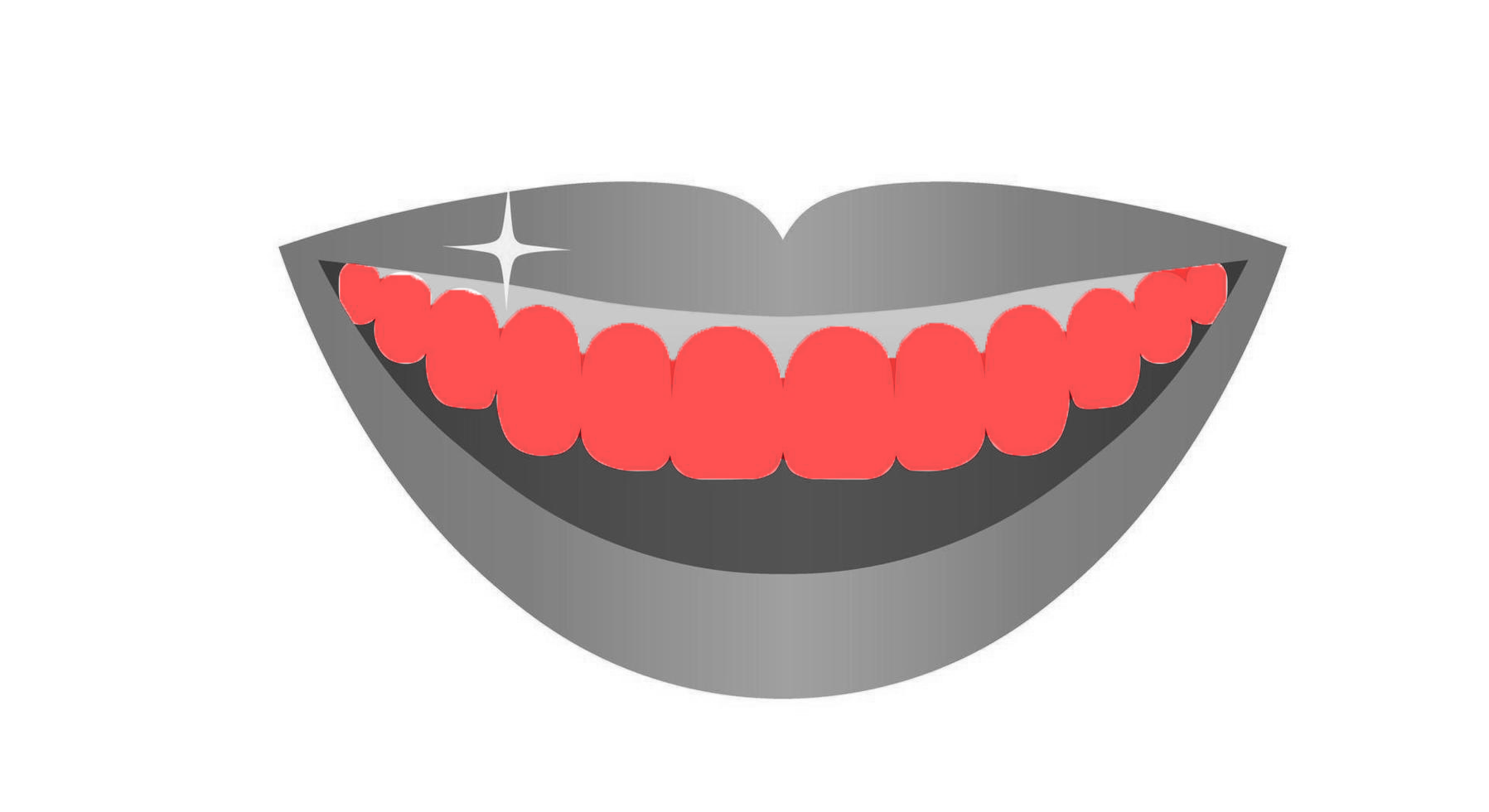 Veneers