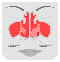 Septoplasty