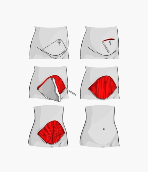 Complete Abdominoplasty