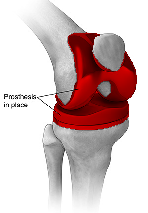 Unilateral Knee Replacement