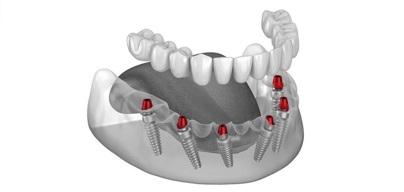 All-On-6 Dental Implants