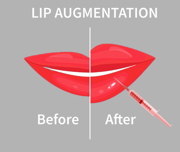 Lip Augmentation