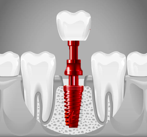 Dental Implant Surgery