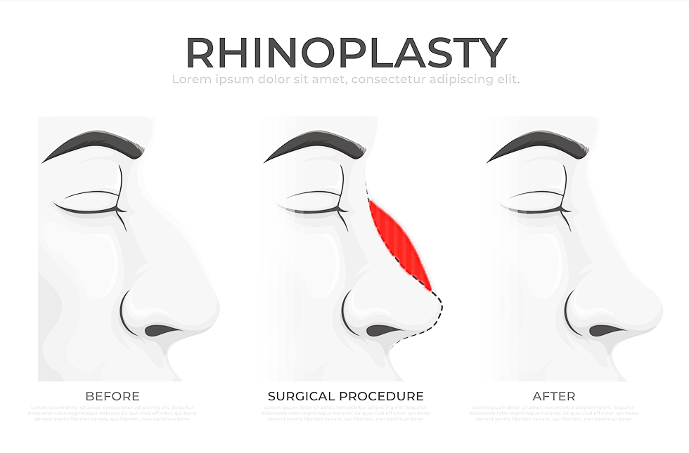 Rhinoplasty