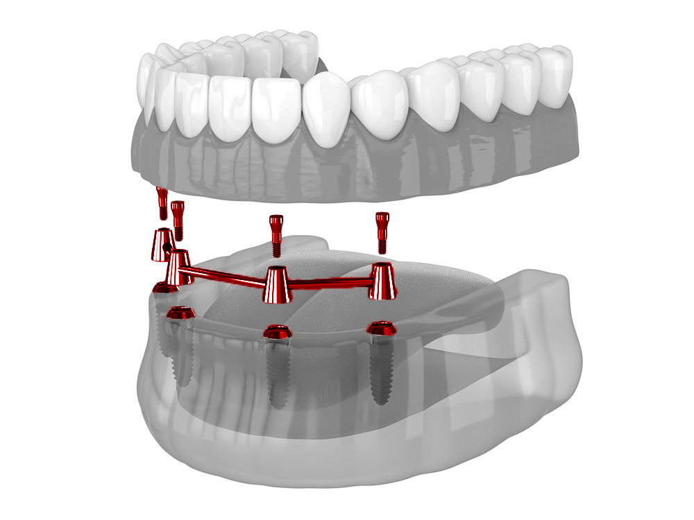 All-On-4 Dental Implants