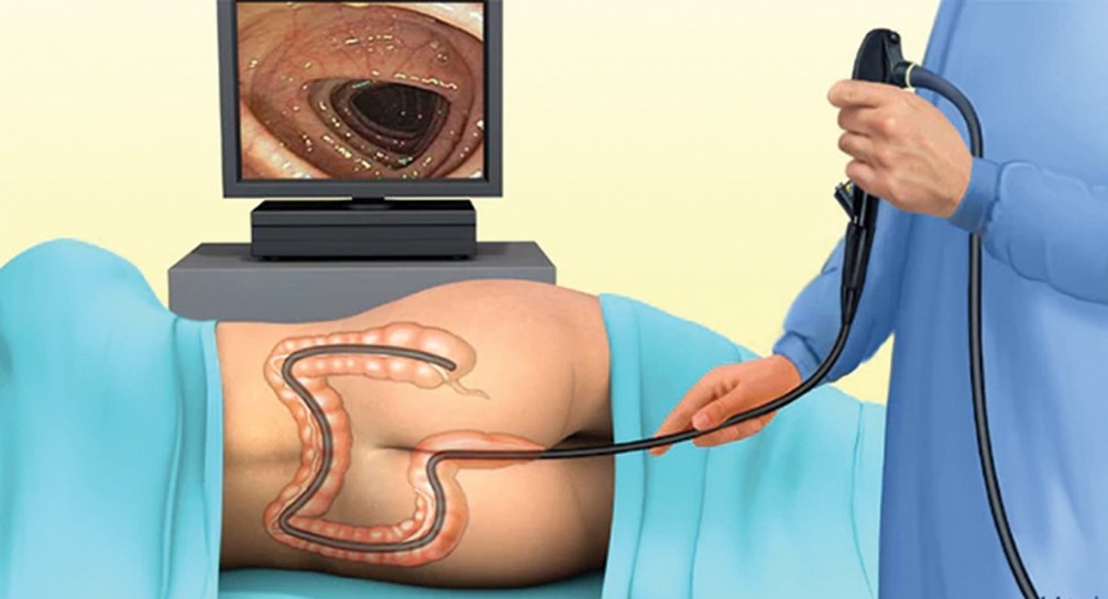 Colonoscopy