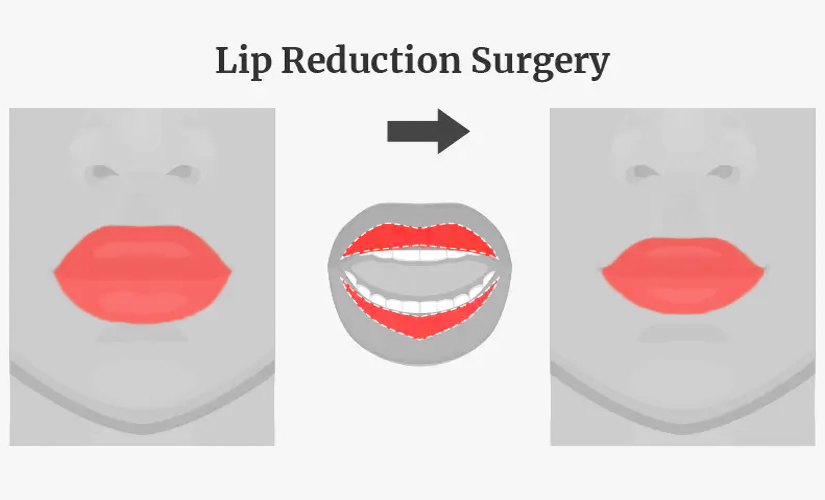 Lip Reduction