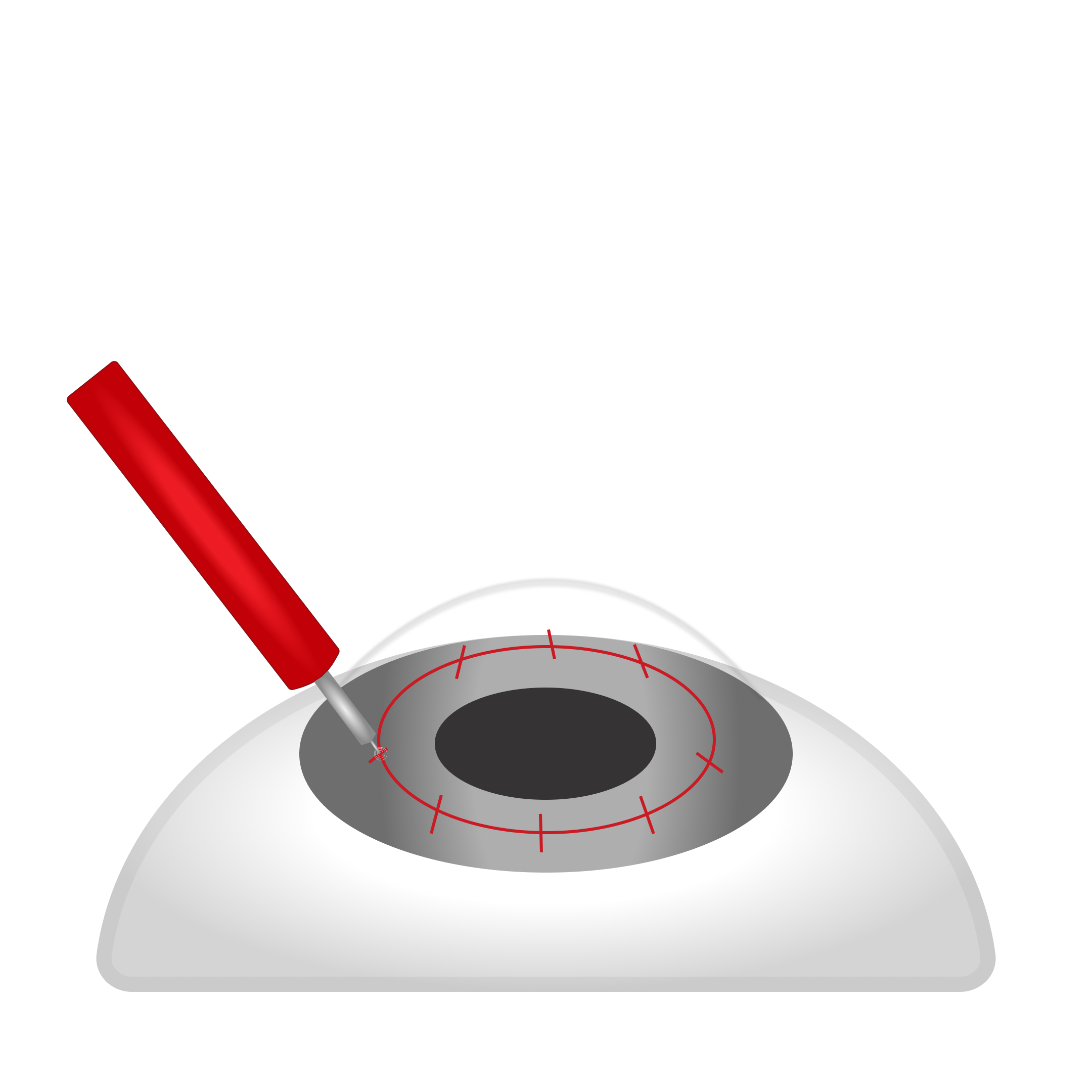 Conductive Keratoplasty