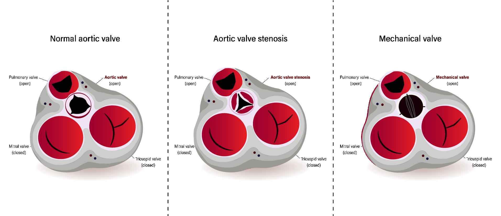 Aortic Valve Replacement