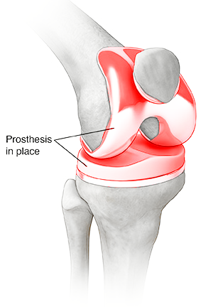 Unilateral Robotic Knee Replacement