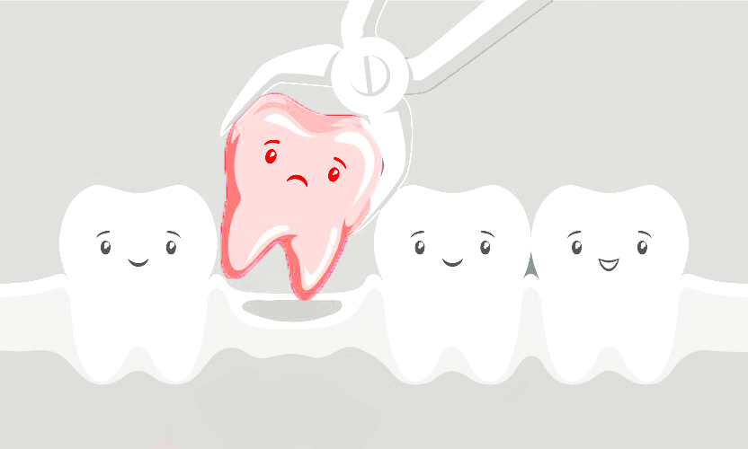 Surgical Tooth Extraction