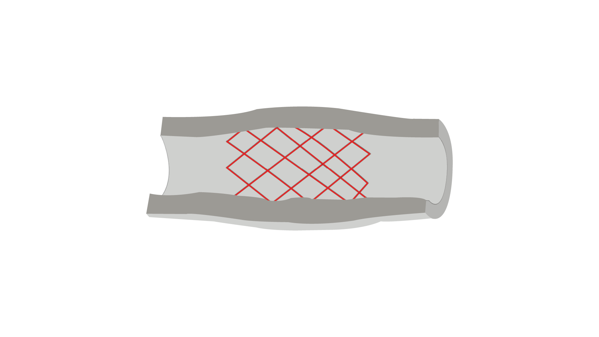 Coronary Stenting