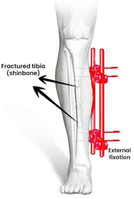Limb Lengthening
